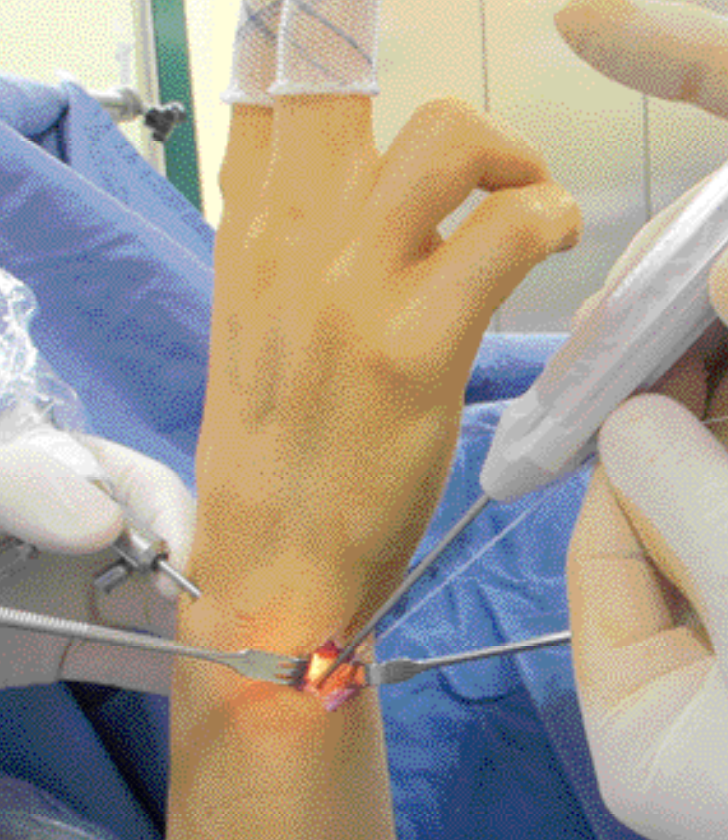 Lesione del complesso fibrocartilagineo triangolare
