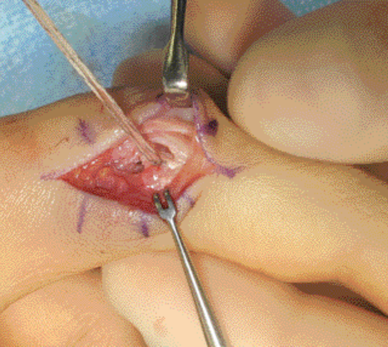 lesioni PIP